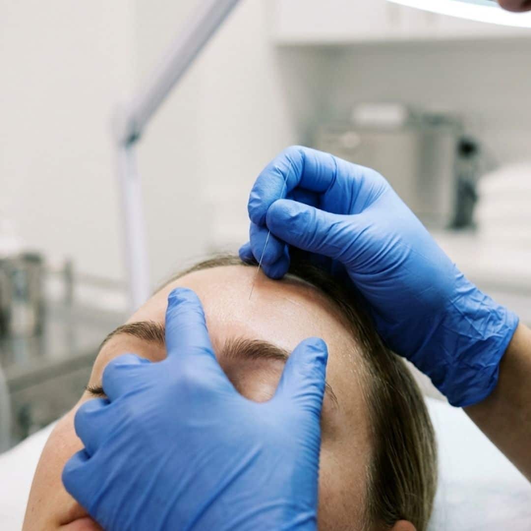 injectable between the brows